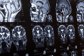 Brain Injury